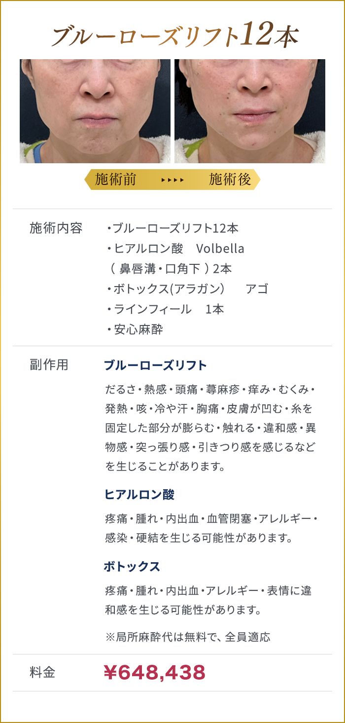 ブルーローズリフト12本施術詳細